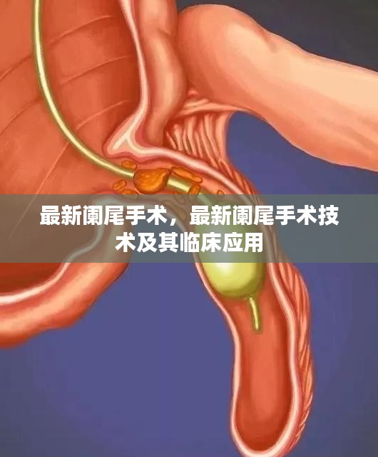 最新阑尾手术技术与临床应用探讨